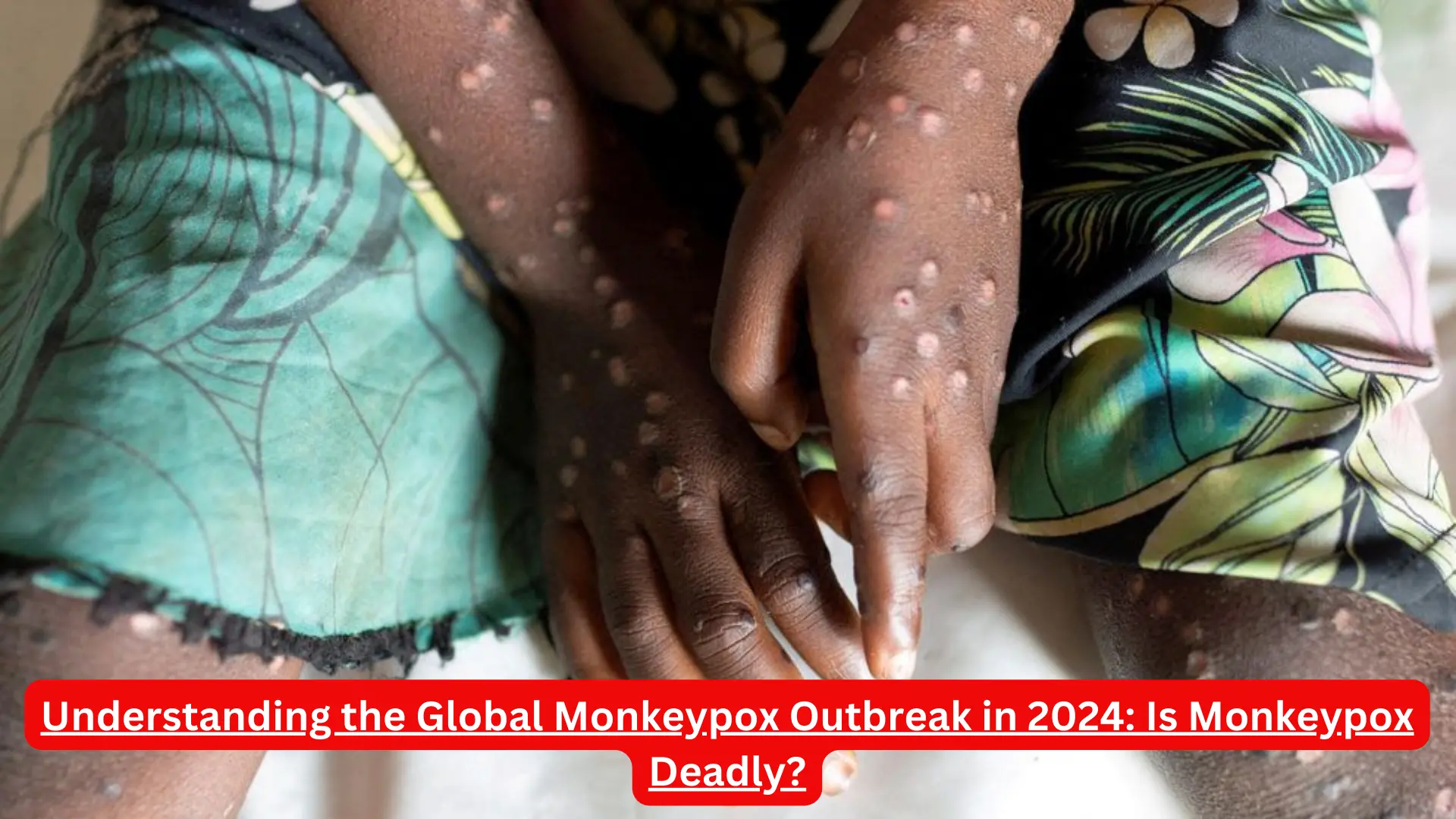 Understanding the Global Monkeypox Outbreak in 2024: Is Monkeypox Deadly?